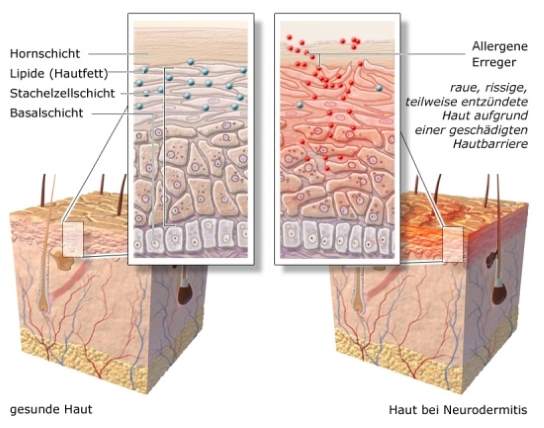 Bild gesunde Haut und Haut mit Neurodermitis